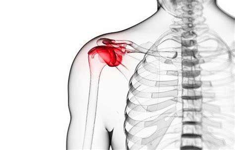Болевые ощущения в плечевом суставе - причины и лечение